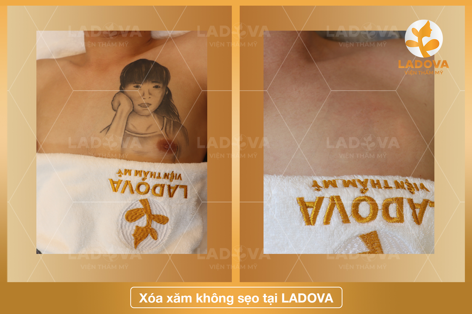 XOA-XAM-BANG-LASER-TAI-LADOVA