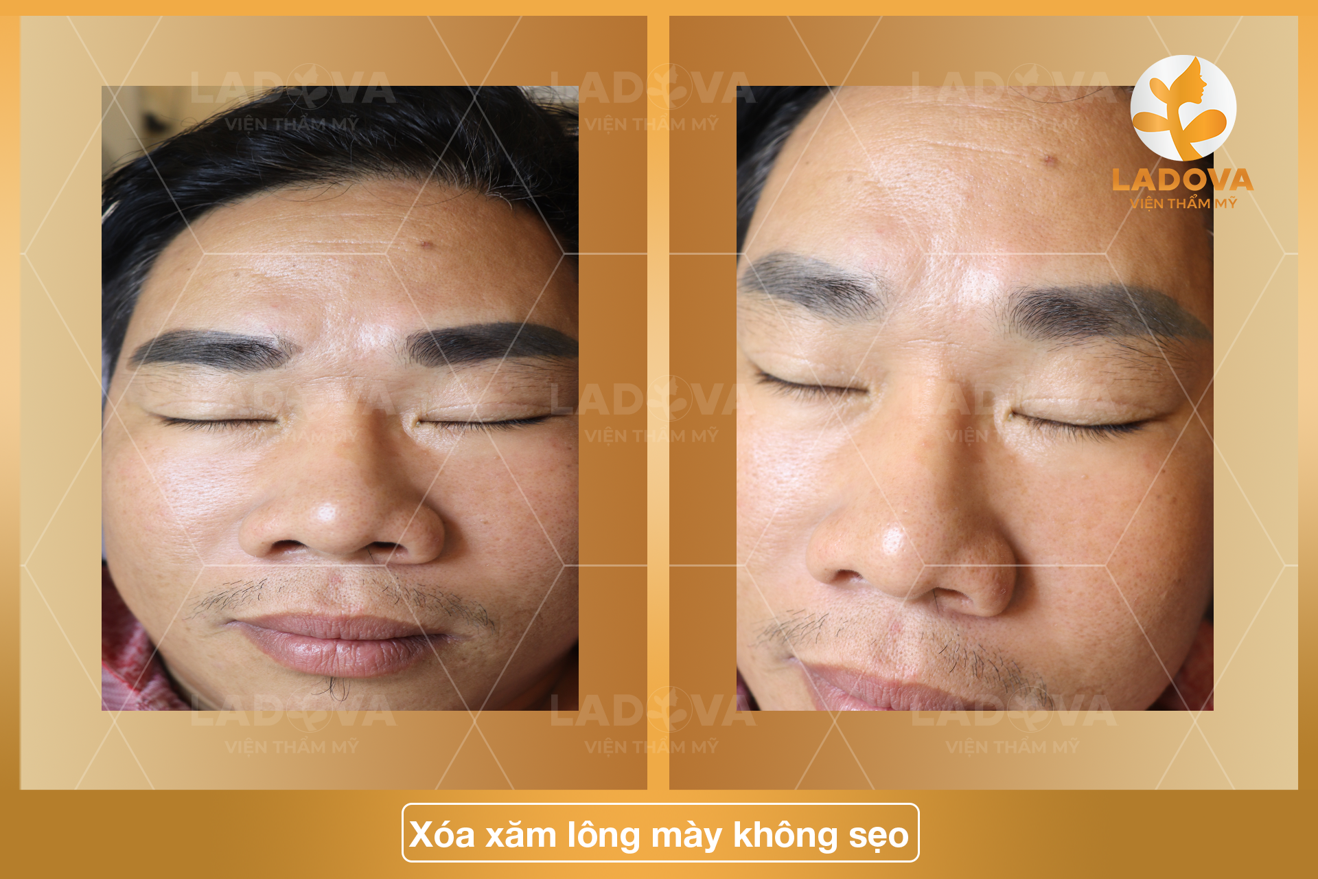 XOA-XAM-LONG-MAY-KHONG-SEO