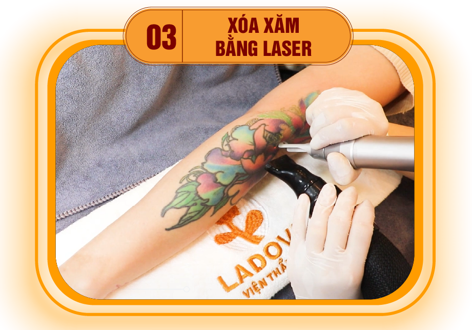 XOA-HINH-XAM-BANG-LASER